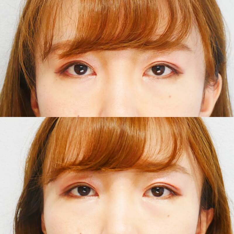 アーモンドアイボトックス 症例