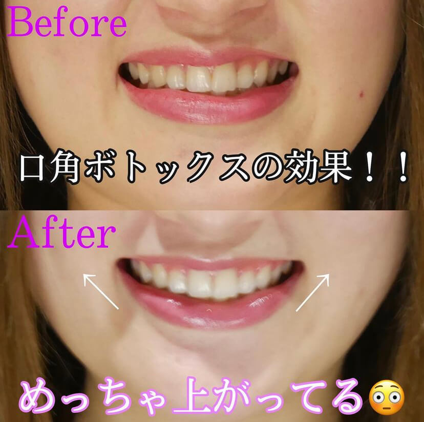 口角ボトックス 症例