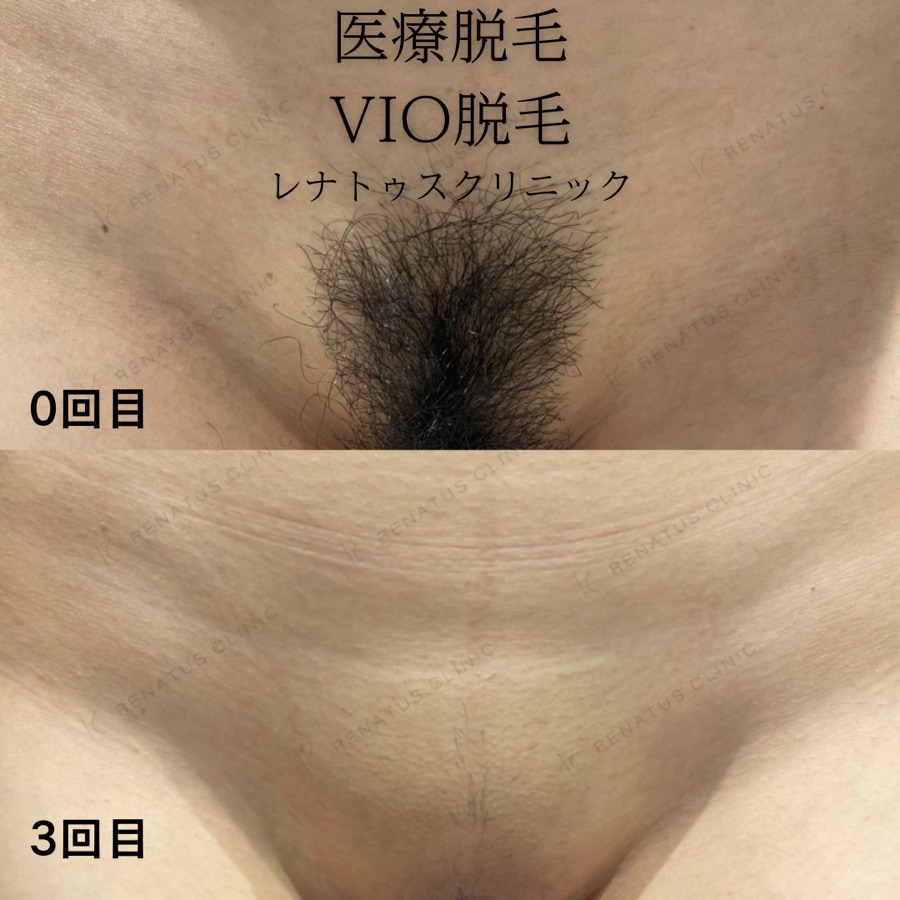 医療脱毛（VIO）施術前後の症例写真
